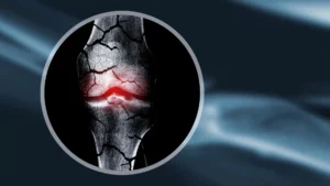 Revolutionary Cell-Free Cartilage Structure Promises Universal Solution for Bone Repair