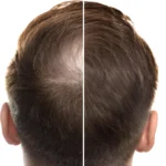 Ancient Root Meets Modern Science: A Centuries-Old Herb Shows Promise for Androgenetic Alopecia