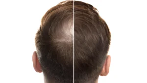 Ancient Root Meets Modern Science: A Centuries-Old Herb Shows Promise for Androgenetic Alopecia