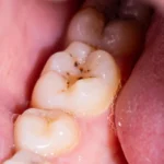 A Revolutionary Dental Gel Promises to Rebuild Damaged Tooth Enamel