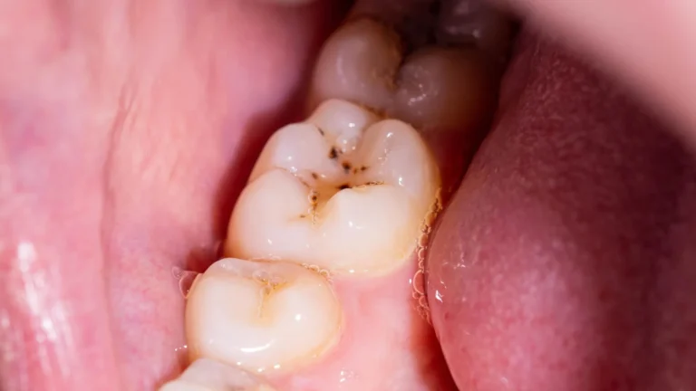A Revolutionary Dental Gel Promises to Rebuild Damaged Tooth Enamel
