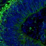 Breakthrough Brain Organoid Research Offers Hope for Personalized Alzheimer’s Treatment and Diagnosis