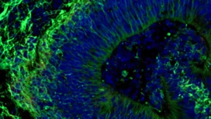 Breakthrough Brain Organoid Research Offers Hope for Personalized Alzheimer’s Treatment and Diagnosis