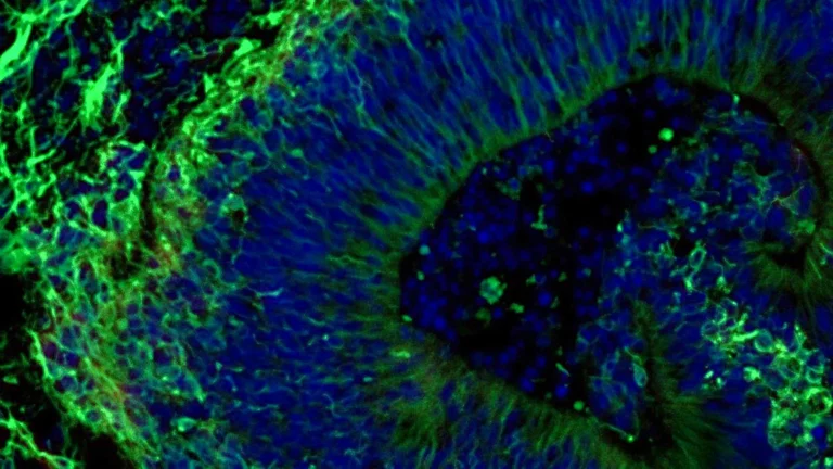 Breakthrough Brain Organoid Research Offers Hope for Personalized Alzheimer’s Treatment and Diagnosis