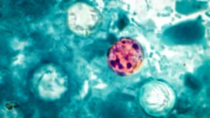 U.S. Health Agencies Investigate Widespread Cyclosporiasis Outbreak Across Multiple States