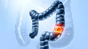 Unraveling a Decade-Old Mystery: How a Gut Toxin Invades Colon Cells Paves Way for Cancer Prevention