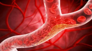 The Silent Threat: Landmark Study Reveals Widespread Atherosclerosis in Young Adults