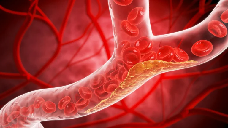 The Silent Threat: Landmark Study Reveals Widespread Atherosclerosis in Young Adults